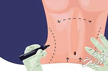 ابدومینوپلاستی سعادت آباد